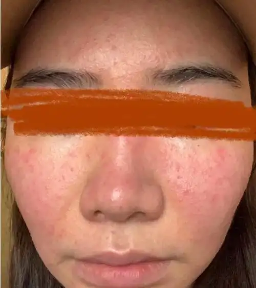 脸部皮肤又红又痒,是过敏了吗?正确的护理方法要牢记