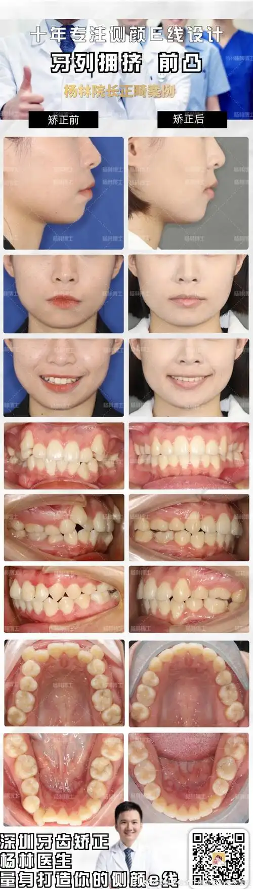 高度不一样,颌骨不对称;从微笑照看,牙齿拥挤,虎牙外露不整齐不好看