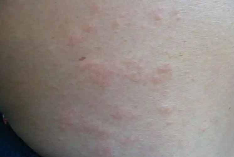 腿部夏季皮炎症状图片大全_有来医生