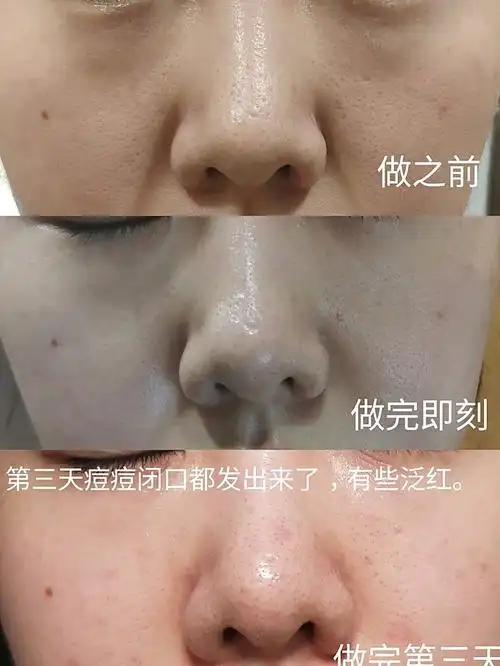 999999油痘皮毛孔粗大星人的第一次果酸换肤体验.