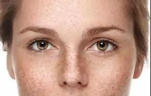 脸上长斑该怎么办好呢_深圳非凡医疗美容医院