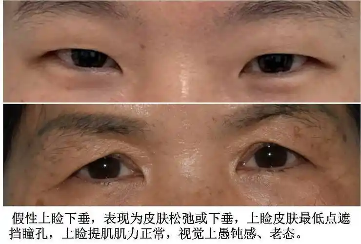 上睑下垂的诊断,治疗和护理_上睑下垂_发病原因_检查_治疗方式_日常