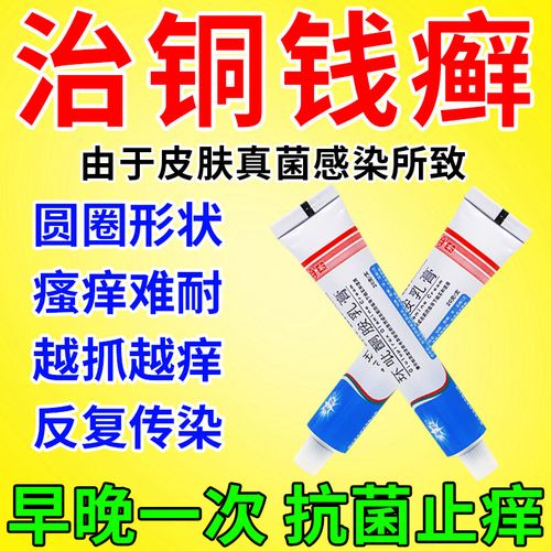 治铜钱癣药 真菌感染引起手癣足癣花斑癣铜钱癣 皮肤瘙痒抗菌止痒 环