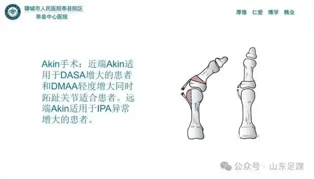 一文了解 | 拇外翻的分型与治疗|手术|畸形|骨性|软组织|关节面|人工