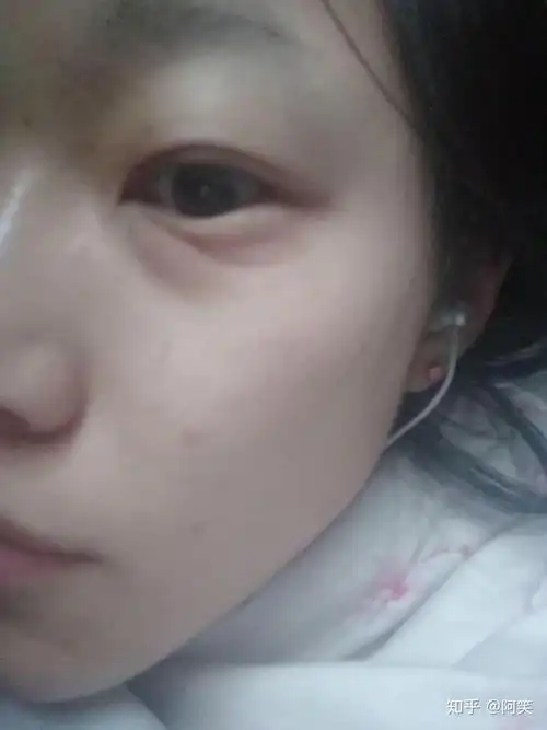 下眼袋突然肿起来是什么回事?