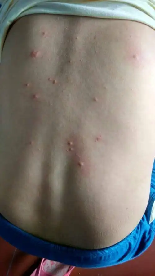 背上睡醒超级痒看了下长了一粒一粒的东西,和蚊子咬了一样,但是不是