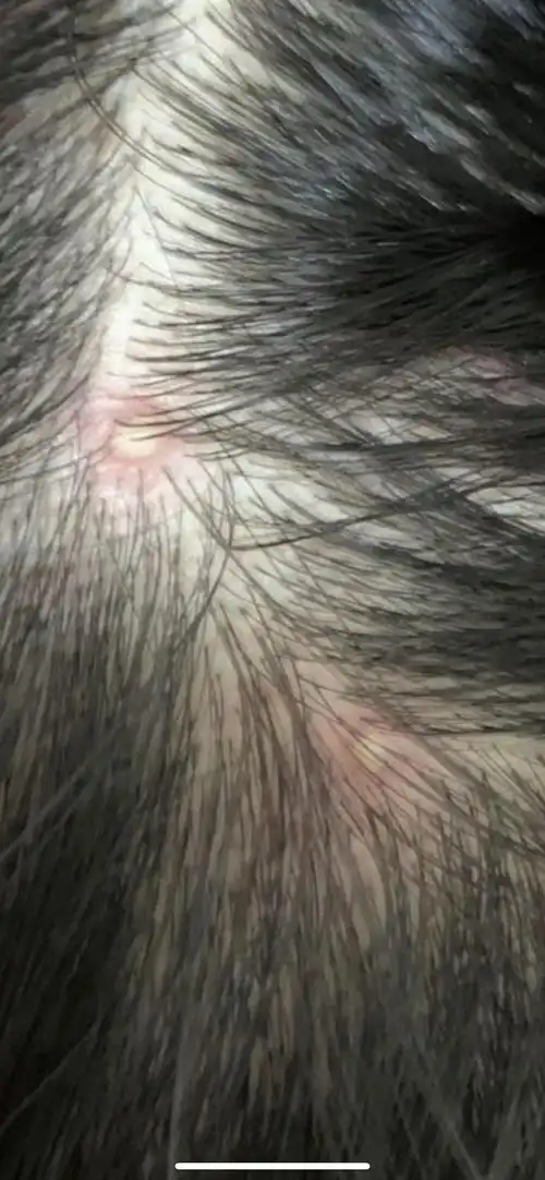 这样的头皮毛囊炎是不是已经很严重了图有点恶慎入