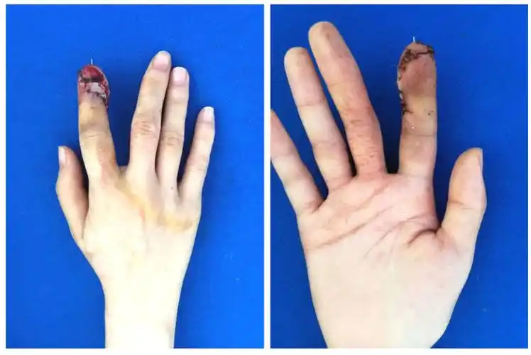 19岁患者成功实现手指再造感叹自己都看不出是造的