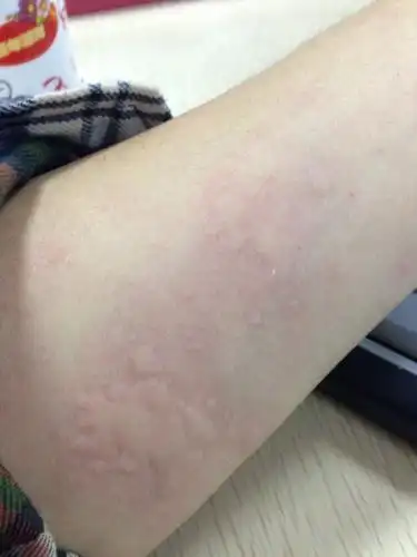 全身发痒然后红肿,像被蚊子咬了一样,查了下是过敏荨麻疹,可是我以前
