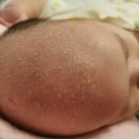 宝宝3个月18天了,头皮和额头上起皮,跟头皮屑一样,用植物油泡完后洗掉