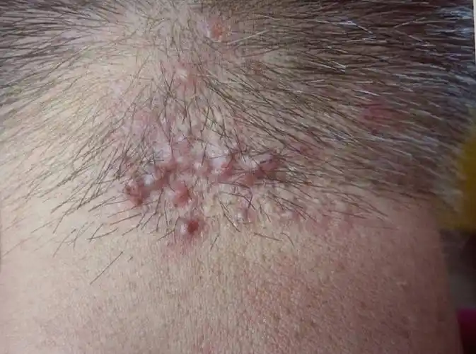 前胸后背,头皮,私处反复长红疙瘩,小心是毛囊炎作祟_医生_治疗_症状