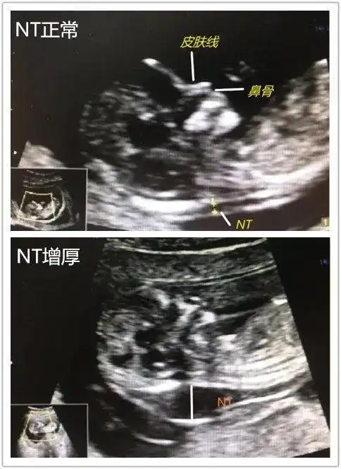 胎儿_筛查_孕妇