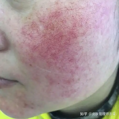 敏感皮肤咋形成