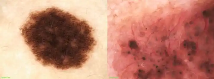 皮肤镜-皮肤科医生的听诊器_进行_镜检查_分析