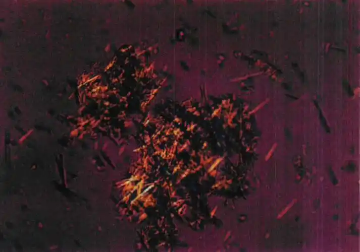 偏振光显微镜下关节液中负性双折光尿酸盐针状结晶