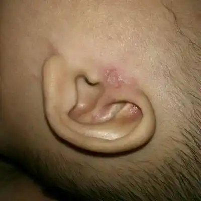 宝宝五个多月,两边耳朵都会有这种红色的东西,我给摸了点湿疹膏也没有