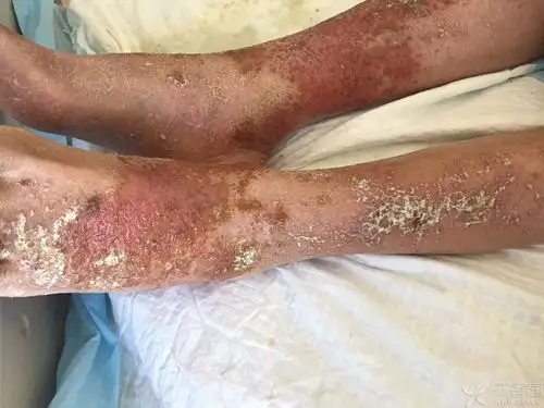 老师求助 全身多处皮肤类似湿疹伴有渗液 - 皮肤与性传播疾病讨论版