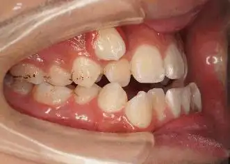 它突出于牙弓之外,因为状似老虎口角的牙齿,所以被称为虎牙,又叫犬齿