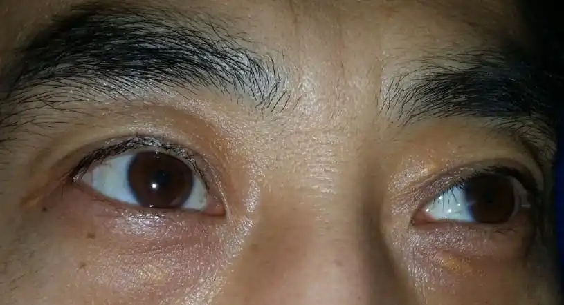 请问一下这眼睛底下的黄色斑点是什么?