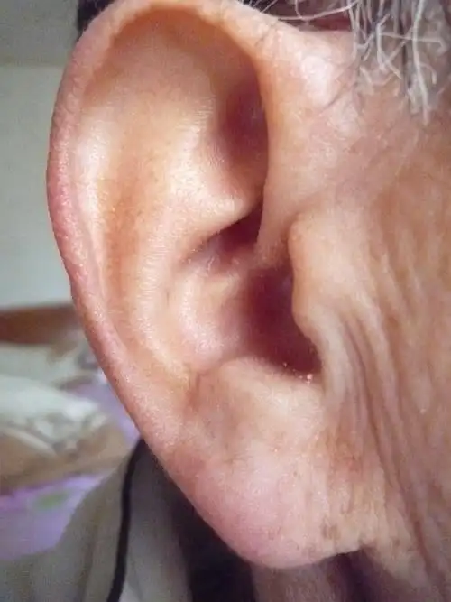 观耳诊病,一目了然