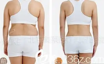 北京腰腹吸脂前后对比图