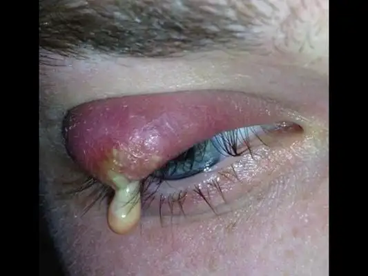 眼皮上长了个疙瘩图片 (13)_有来医生