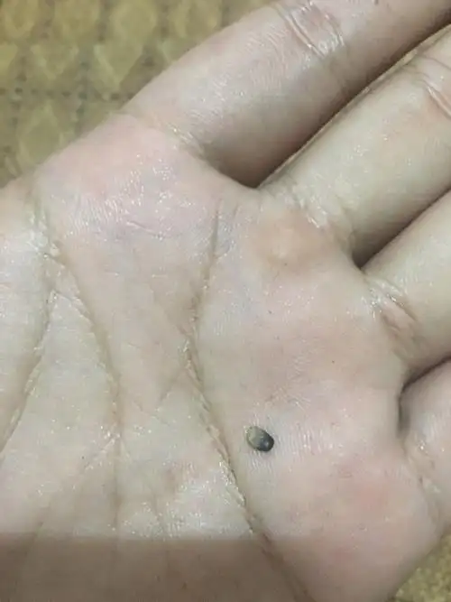 阴囊有一颗芝麻一样黑色