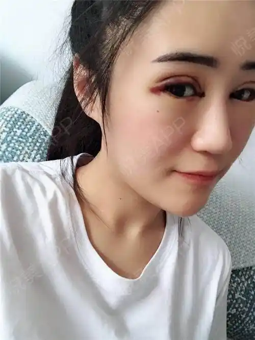 全切双眼皮术后3天_眼部多项术后3天_双眼皮术后3天_眼部整形术后3天