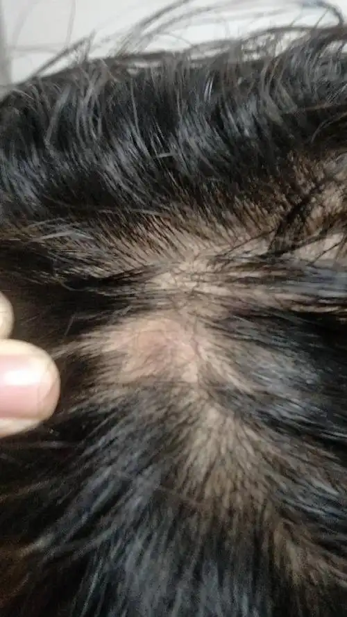 我的头皮上起了这些疙瘩,上面已经没有头发了,怎么回事,该用什么药