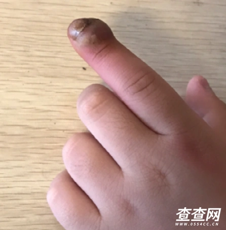 小孩从小就一直啃手指,一年要发作一到两三次甲沟炎!