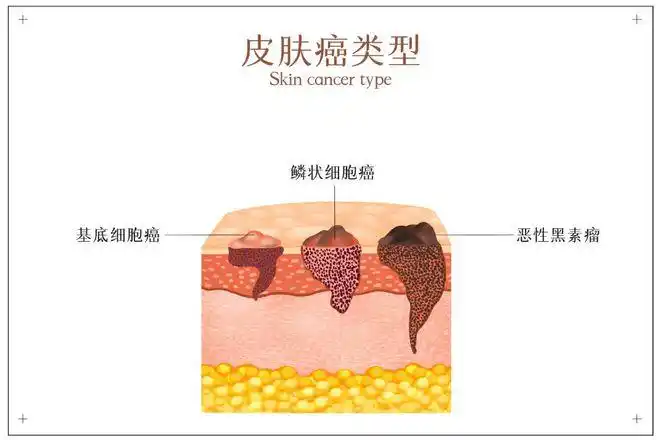 外阴癌(carcinoma of the vulva)是一种少见的恶性肿瘤,占所有女性