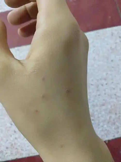 珠海哪里治疥疮医院-珠海好的皮肤科_珠海治疗皮肤病较好的医院_珠海