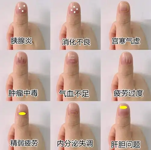 每日即傲一招中医不外传手诊观察指甲就能自查身体健康