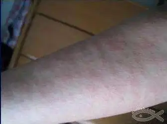 你已进入"虫咬皮炎"高发期!|湿疹|瘙痒|皮肤病