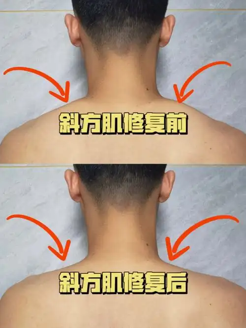 双下巴斜方肌肥厚颈椎不适看过来