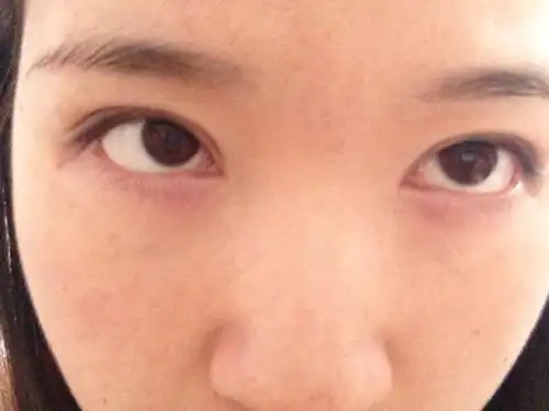 两眼下眼皮皮肤发白怎么办啊