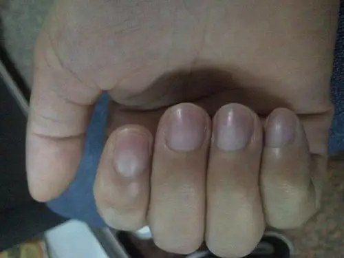 我的指甲为什么是发紫的,好像有几年了,不过身体很健康