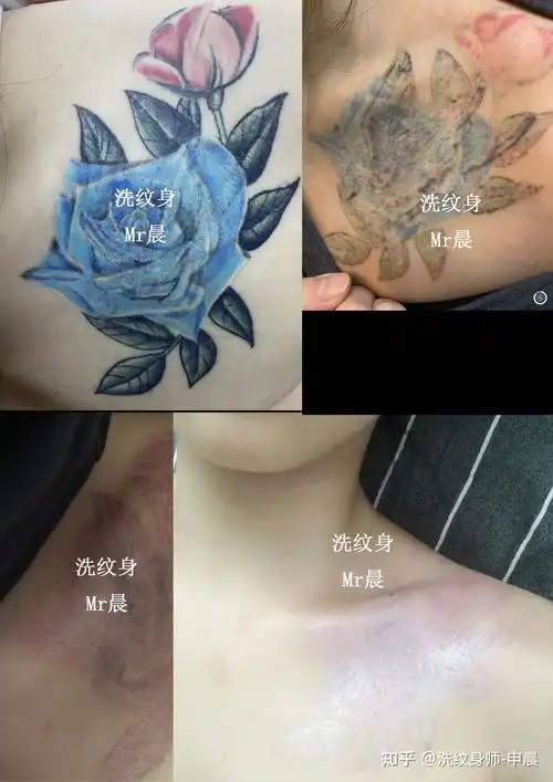 如果你想洗纹身.这篇文章一定要看! - 知乎