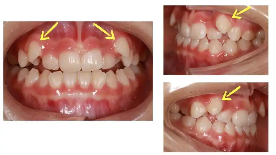 虎牙长得太丑了好想直接拔掉啊