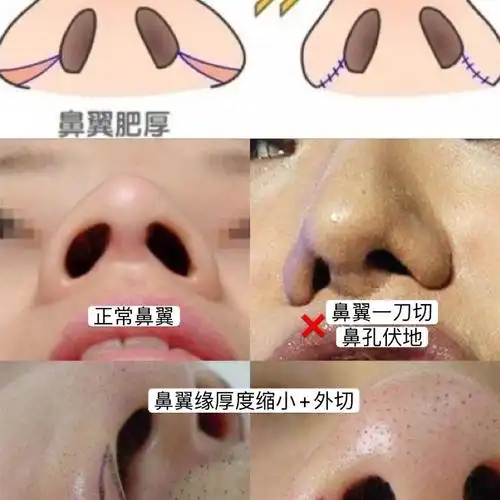 不少姐妹还想让我讲讲鼻翼,确实鼻头鼻翼大哥不说二哥_圈子-新氧美容