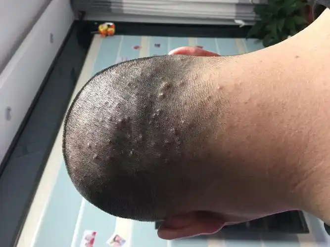 我老公脑袋上面起了很多疙瘩,挺严重的,怎么办?