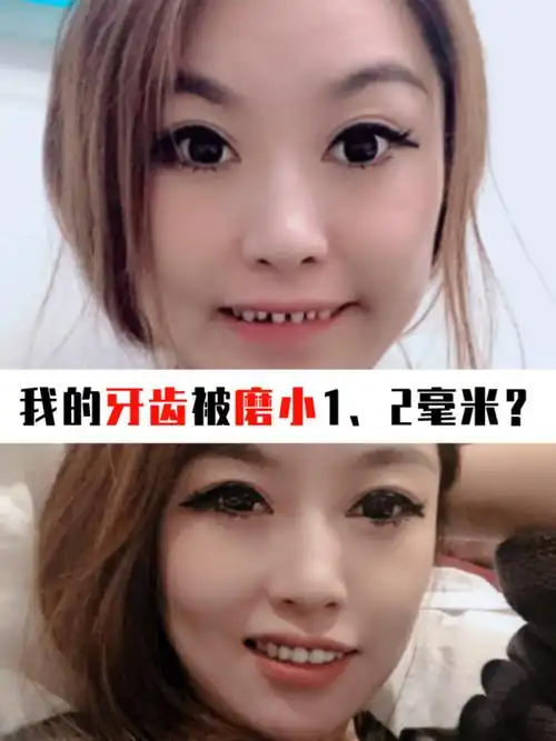 全瓷牙初体验,把牙磨小了1,2毫米