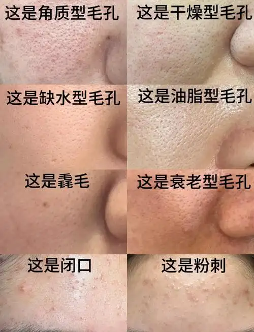 大毛孔缩小秘诀,轻松搞定!