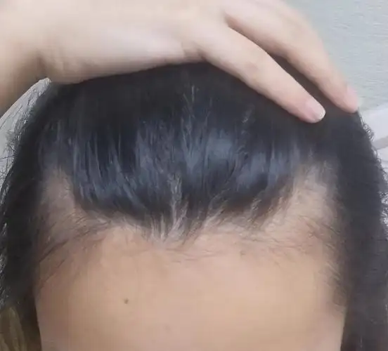 求看我需要去医院吗,m秃好像有点严重,侧面头发贼少