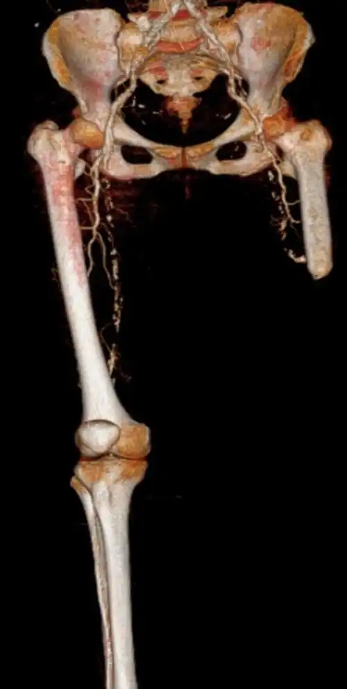 因为同样的症状7年前左腿截肢现在右腿还能保住吗