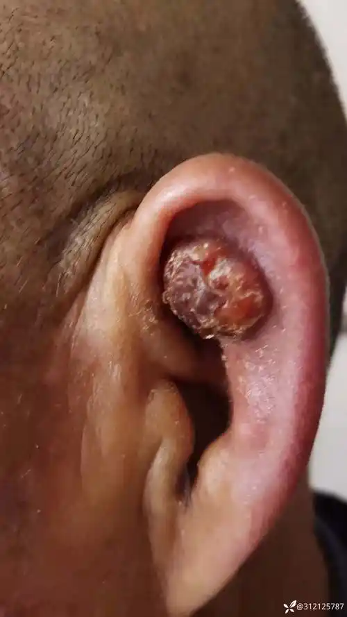 耳廓肿瘤困扰一例