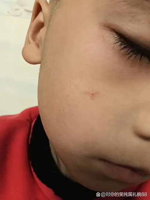 小孩脸上长有红血丝状,请皮肤科的专家帮忙看看这个是什么情况,谢谢啦