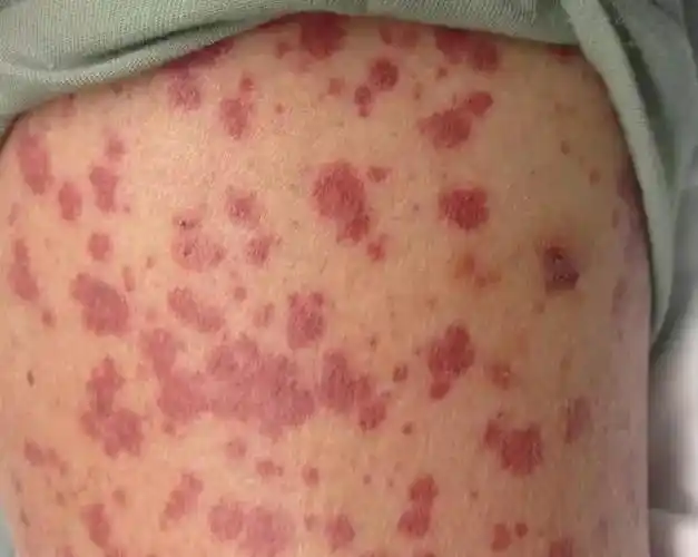 图文盘点肢端分布的血管性皮肤病