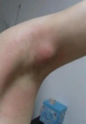 腋下长了个大肿块 不可移动痛,周围痒,肿块发热是什么啊 会不会是肿瘤