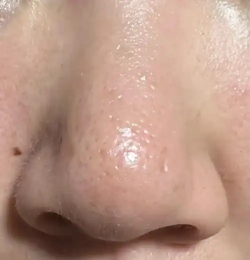 鼻子毛孔粗大,卡粉到怀疑人生💥_粉底液_毛孔_毛孔粗大_美妆_护肤_